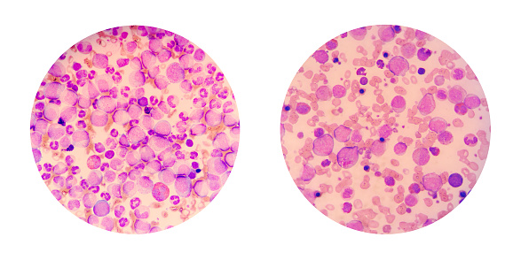 Microscopic views of a blood smear from leukemia patient show many abnormal white blood cells, cancer cells in their blood