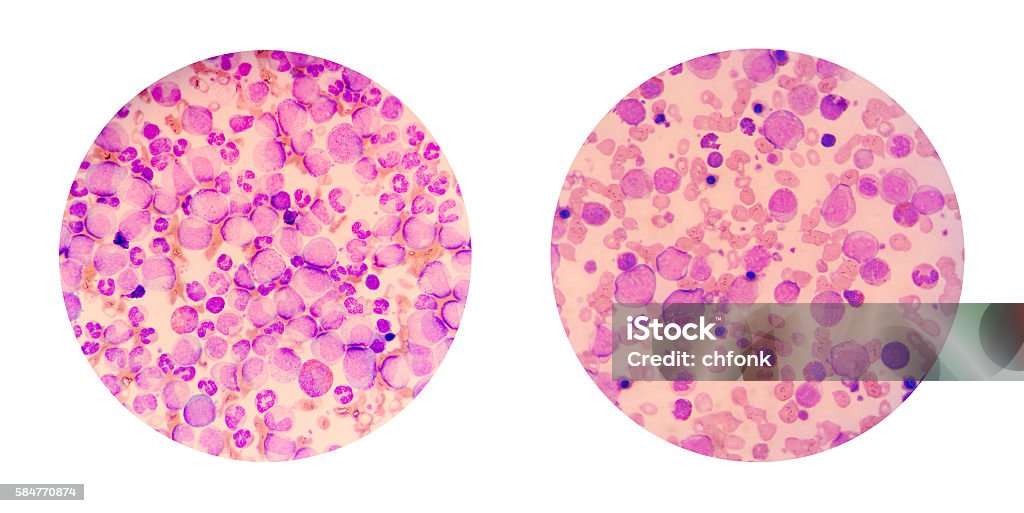 Microscopic views of a blood smear from leukemia patient Microscopic views of a blood smear from leukemia patient show many abnormal white blood cells, cancer cells in their blood Chronic Granulocytic Leukemia Stock Photo