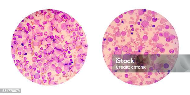 Microscopic Views Of A Blood Smear From Leukemia Patient Stock Photo - Download Image Now