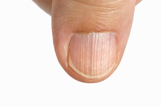 crêtes verticales sur les symptômes des ongles - nail file photos et images de collection