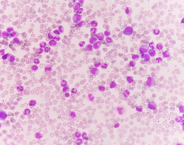 istock Leukemia blood picture. 585059188