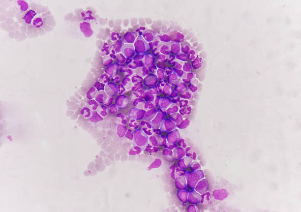 istock Leukemia blood picture. 585059592