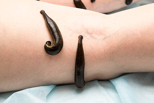 Treatment of people of medical leeches. Treatment with leeches thrombophlebitis of the lower limbs of an adult woman. Treatment of people with the help of medical leeches, eastern medicine, alternative methods of treatment of the human. Treatment with leeches degenerative disc disease of the lumbar spine. bloodsucking photos stock pictures, royalty-free photos & images