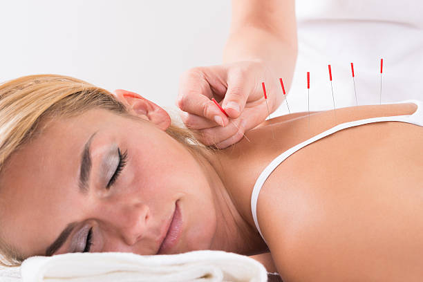 hand performing acupuncture therapy on customer's back - acupuncturist imagens e fotografias de stock