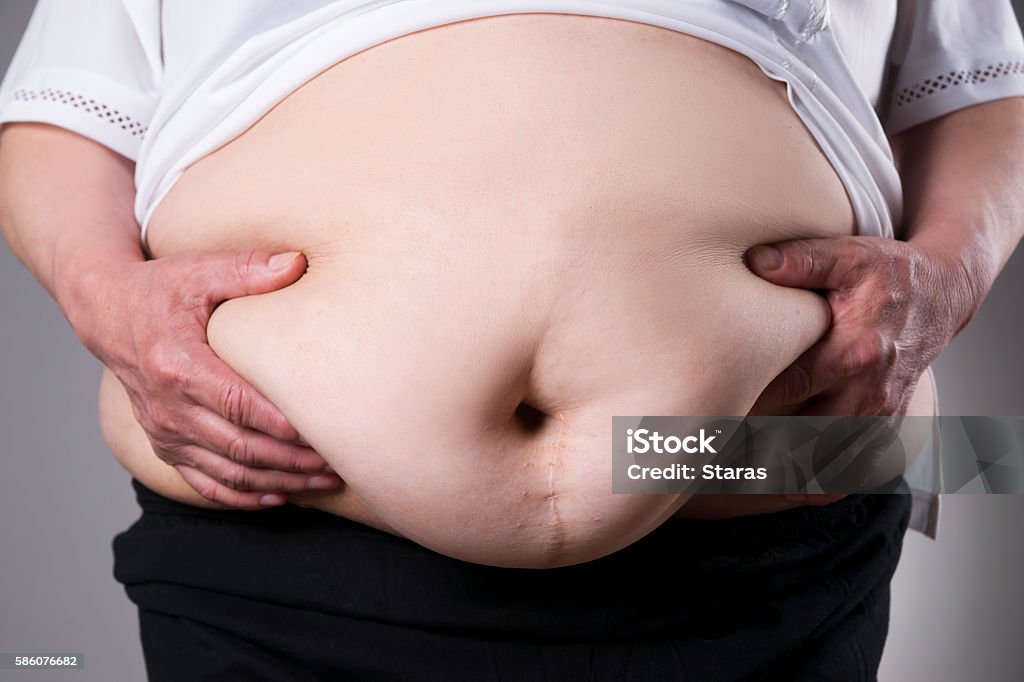 Obesity woman body, fat female belly with a scar Obesity woman body, fat female belly with a scar from abdominal surgery close up on gray background Caesarean Section Stock Photo