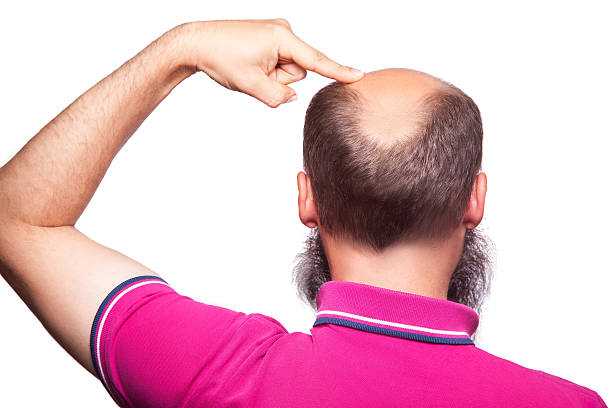 istock man alopecia baldness hair loss isolated. 586348006