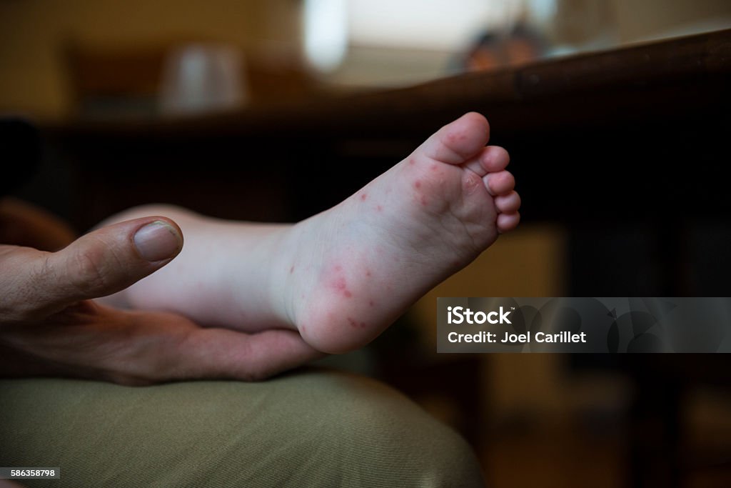 Baby with Hand, Foot, and Mouth Disease A father holds his baby girl who has Hand, Foot, and Mouth Disease, which is a comon infection caused by a group of viruses. Hand Foot and Mouth Disease Stock Photo