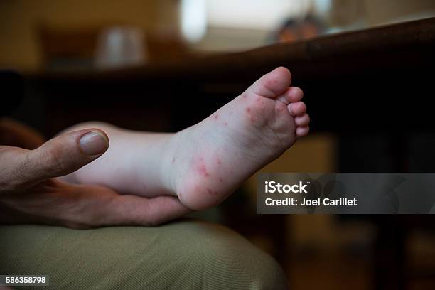 Baby With Hand Foot And Mouth Disease Stock Photo - Download Image Now - Hand Foot and Mouth Disease, Foot And Mouth Disease, Baby - Human Age