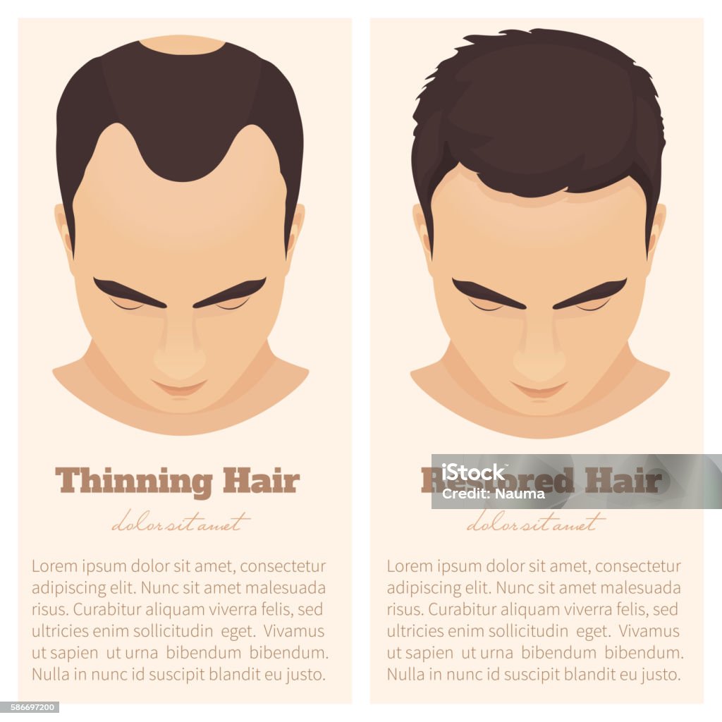 Male Pattern Baldness Design Template Stock Illustration - Download Image  Now - Above, Men, Adult - iStock