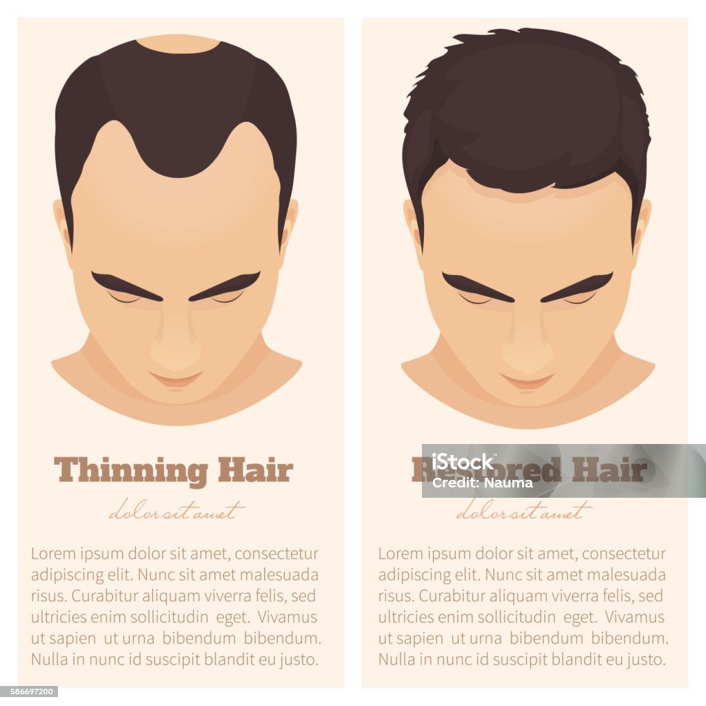 Male Pattern Baldness Design Template Stock Illustration - Download Image Now - Above, Men, Adult - iStock Male Pattern Baldness Design Template Stock Illustration - Download Image Now - Above, Men, Adult - iStock