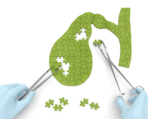 Gallbladder surgery operation (medicine puzzle concept) Gallbladder puzzle concept: hands of surgeon with surgical instruments (tools) performs gallbladder surgery as a result of cholelithiasis, cholecystitis, cholecystectomy, biliary dyskinesia cnidarian stock pictures, royalty-free photos & images