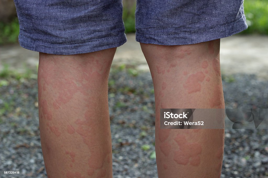 skin allergies, legs  women. skin allergies, legs women. Hives - Skin Condition Stock Photo