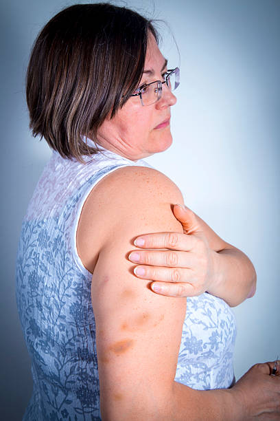 istock Adult patient showing bruises 587930274