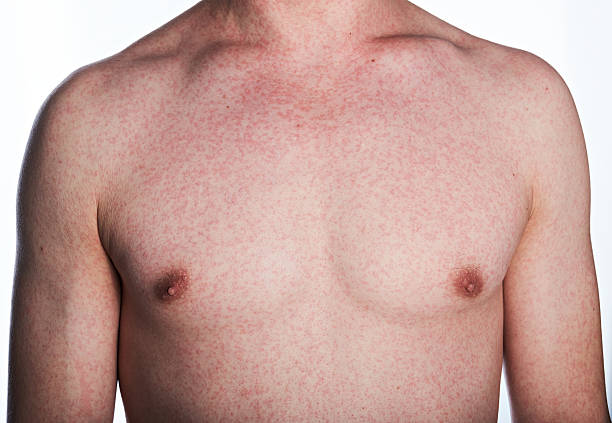 istock Allergy reaction on skin 589101254