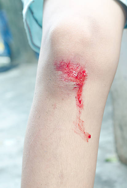 bleeding scraped human knee after falling from bike stock photo