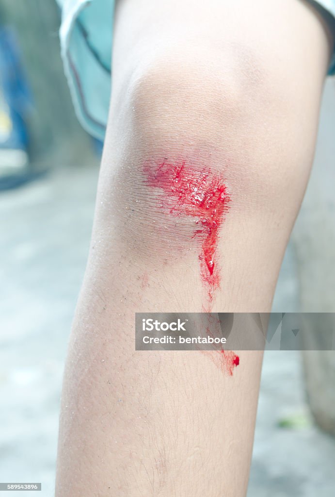 chảy máu đầu gối người sau khi ngã từ xe đạp - Trả phí Bản quyền Một lần Động vật lột xác Bức ảnh sẵn có