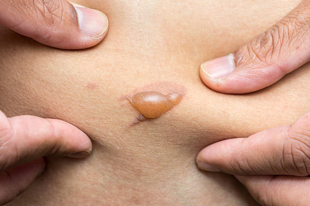 istock close up blister from scald on the skin 590156666