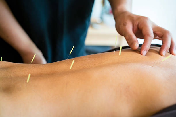 일본 교토 전문가와 침술 치료를 받은 여성 - acupuncture needle 뉴스 사진 이미지