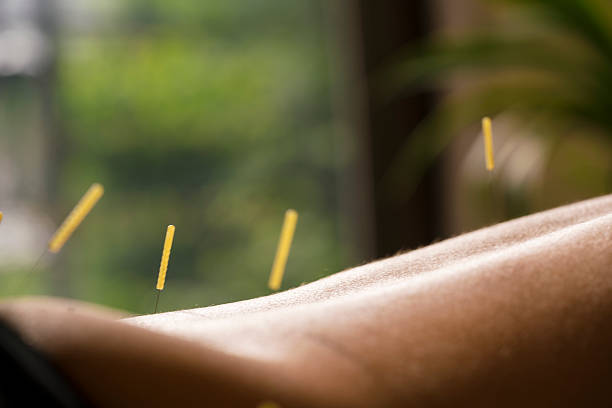 일본 교토전문가와 침술 치료를 받고 있는 여성 - acupuncture needle 뉴스 사진 이미지
