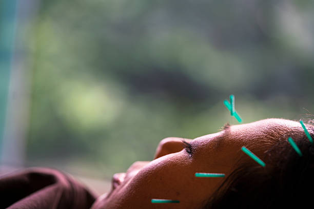 일본 교토침치료 - acupuncture needle 뉴스 사진 이미지