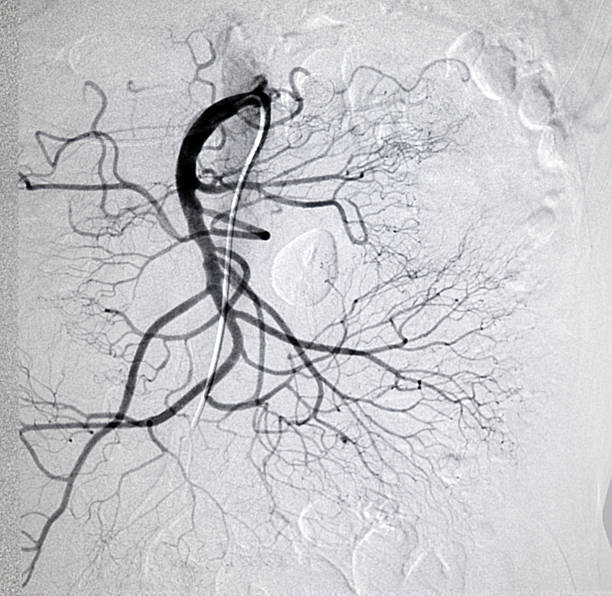 mesenteric artery DSA image mesenteric artery and branches  of DSA. artery photos stock pictures, royalty-free photos & images