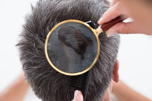 Dermatologist Checking Patient's Hair In Magnifying Glass High Angle View Of Dermatologist Checking Patient's Hair In Magnifying Glass dandruff men stock pictures, royalty-free photos & images