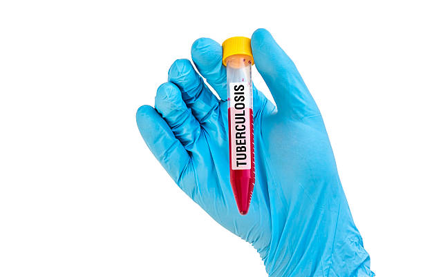 istock Test-tube with blood sample for TUBERCULOSIS 592407428