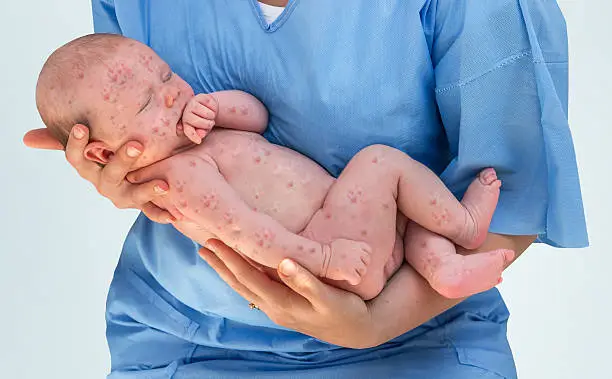 Doctor holding a beautiful newborn baby which is sick rubella or measles