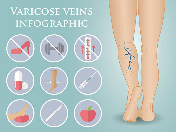 illustrations, cliparts, dessins animés et icônes de infographie vectorielle de phlébologie - venous insufficiency