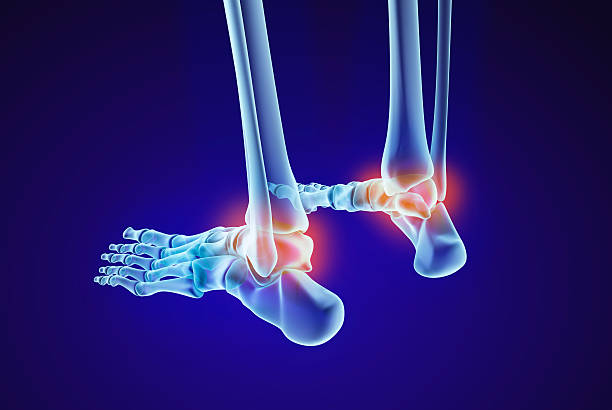 istock Skeletal foot - injuryd talus bone. Xray view. 594059874