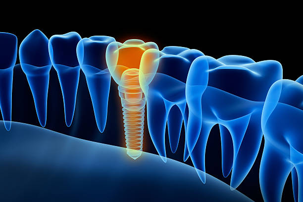 vue radiographique de prothèse avec implant.  vue aux rayons x. - artificial metal healthcare and medicine technology photos et images de collection