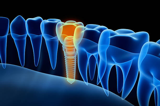vista a raggi x della protesi con impianto.  vista a raggi x. - impianto dentale foto e immagini stock