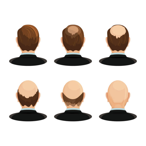 ilustraciones, imágenes clip art, dibujos animados e iconos de stock de concepto de alopecia. conjunto de cabezas que muestran el progreso de la pérdida de cabello. - completely bald