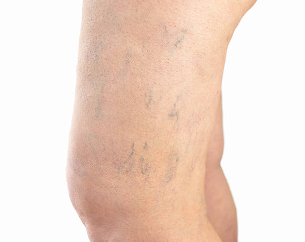 Varicose veins in the leg woman with varicose vein in leg isolated on white background spider veins stock pictures, royalty-free photos & images
