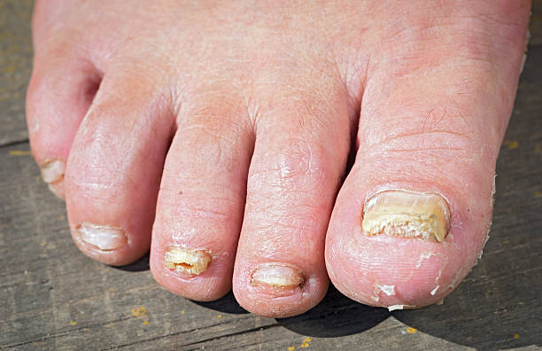 人間の足の爪の真菌感染症 - fungus toenail human foot onychomycosis ストックフォトと画像