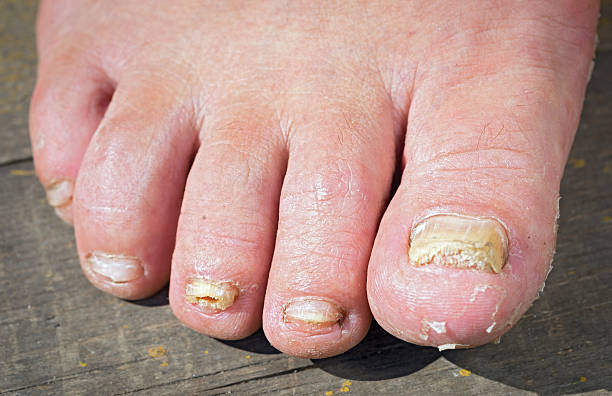 fungo infecção com unhas de homem de pé - fungus toenail human foot onychomycosis imagens e fotografias de stock