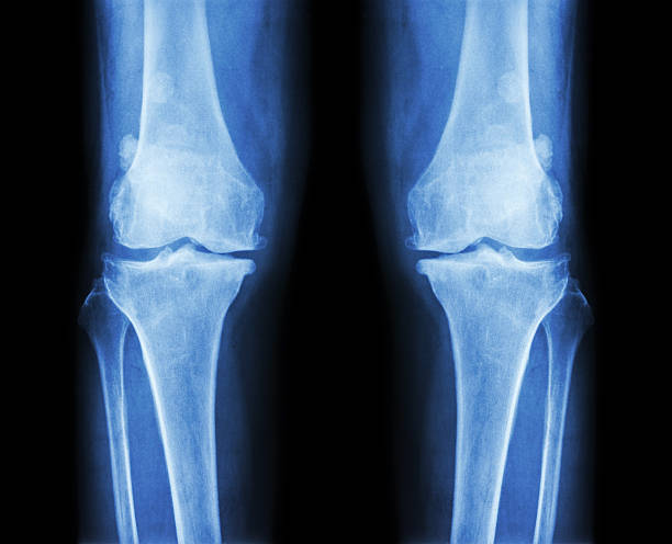 Osteoarthritis both knee Osteoarthritis both knee .  film x-ray AP ( anterior - posterior ) of knee show narrow joint space , osteophyte ( spur ) , subcondral sclerosis fibula stock pictures, royalty-free photos & images