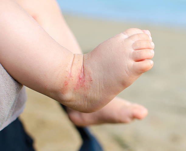 atopische dermatitis neugeborenen füße ekzeme - eczema stock-fotos und bilder