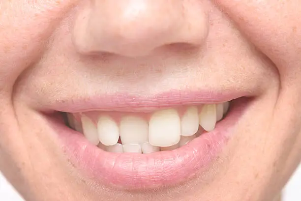 Photo of woman crooked teeth