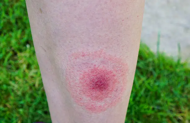 Photo of Lyme disease, Borreliosis or Borrelia, typical lyme rash, spot.