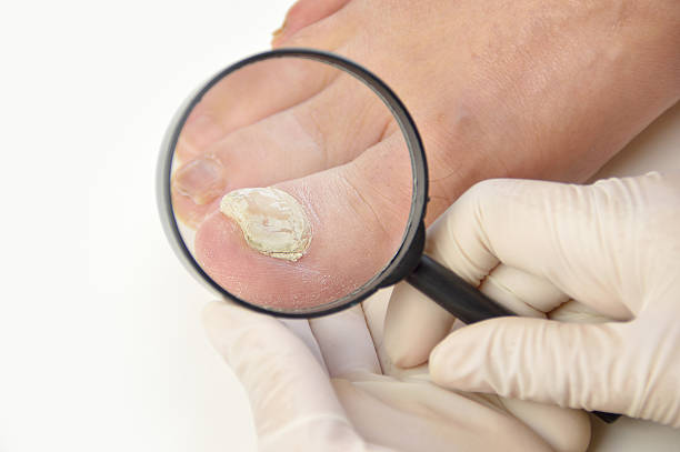 podiatrist überprüfen einen kranken nagel - fungus toenail human foot onychomycosis stock-fotos und bilder