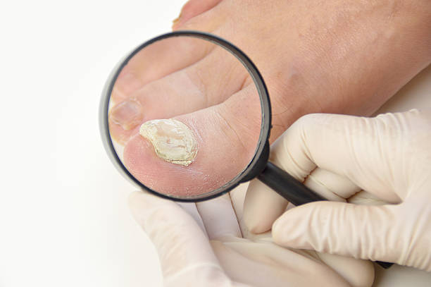 podiatrist checking a sick nail Close up image of left foot toe nail suffering from fungus infection. Checking it with magnifying glass by the medical doctor trichophyton fungus stock pictures, royalty-free photos & images