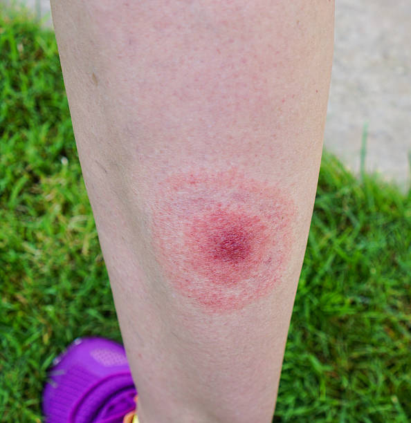 lyme disease, borreliosis or borrelia, typical lyme rash, spot. - lyme disease imagens e fotografias de stock