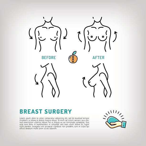 Augmentation Breast plastic surgery icons. Silicone implants, Thin line symbols Augmentation Breast surgery icons, silicone implants. Body Plastic surgery concept thin line icons. Medical symbols and cosmetic surgery before and after. Vector illustration silicone implants stock illustrations
