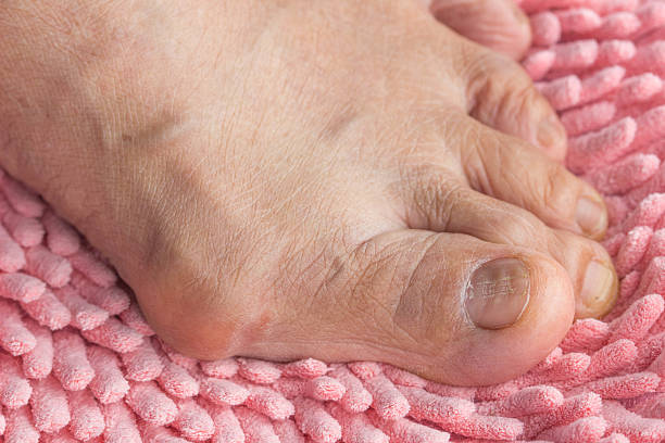 hallux valgus su raschietto rosa - human foot bunion pain human toe foto e immagini stock