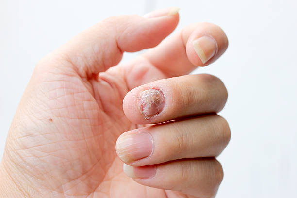 istock Fungus Infection on Nails Hand, Finger with onychomycosis. 598235966