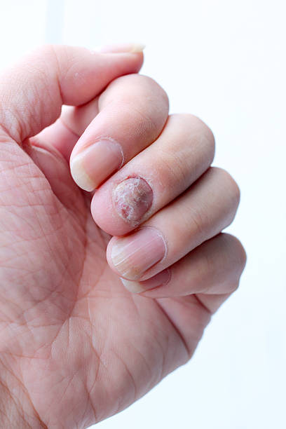 istock Fungus Infection on Nails Hand, Finger with onychomycosis. 598236076