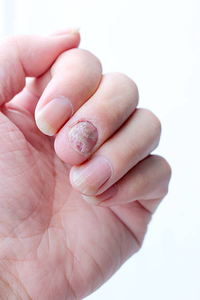 istock Fungus Infection on Nails Hand, Finger with onychomycosis. 598236142