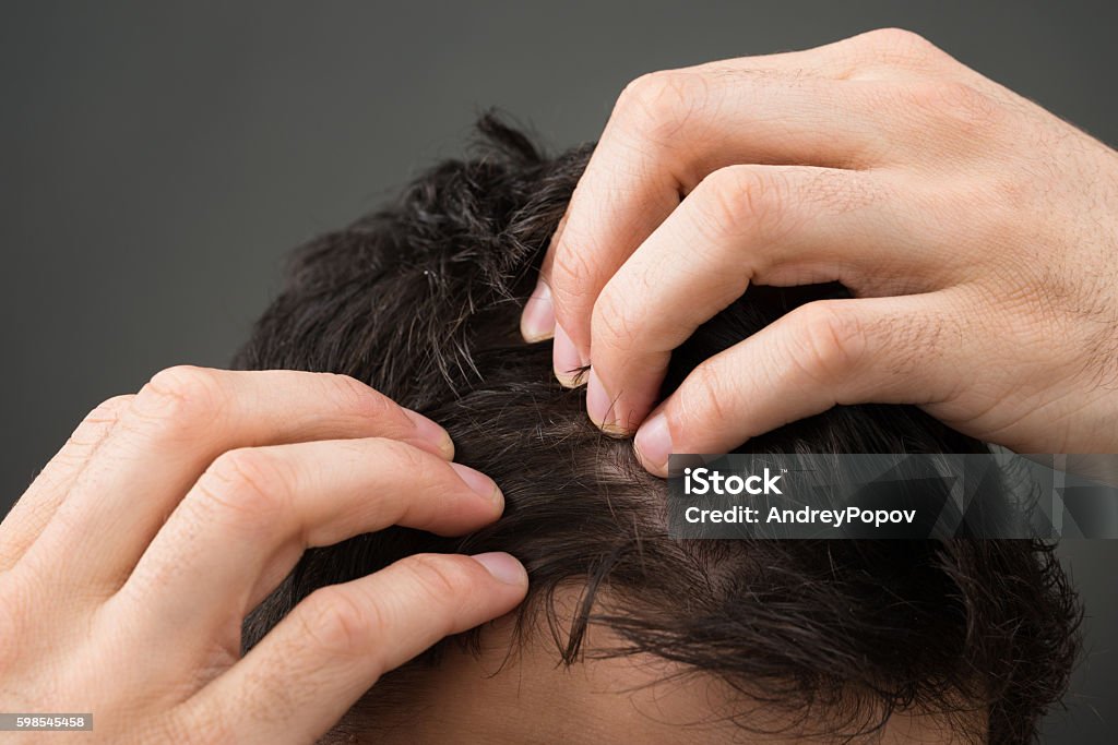 Cropped Image Of Man Suffering From Hair Loss Stock Photo - Download Image  Now - Men, Human Hair, Hair Treatment - iStock