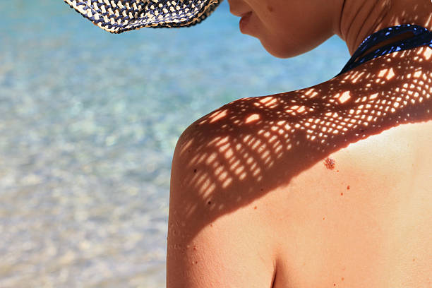 Beautiful Woman with birthmarks on her back and face. Attractive female wearing straw hat on the beach